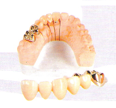 金属烤瓷冠 烤瓷牙;铸造冠桥;铸造支架;隐形义齿;活动矫正器;活动矫正器;防夜磨牙垫;牙齿漂白套;胶托排牙;二氧化锆全瓷牙;铸瓷牙;纯钛烤瓷牙; 青岛金美冠精密义齿制作有限公司